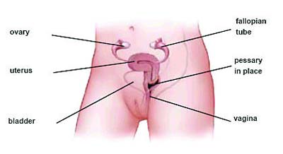 What are the symptoms of vaginal pessary?