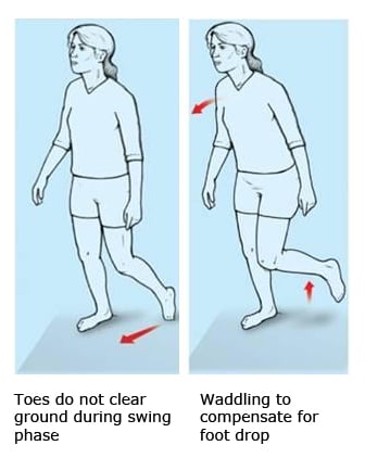 Foot drop makes walking laboured and unbalanced