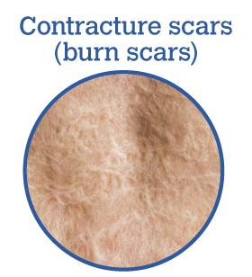 Contracture (Burn) Scars