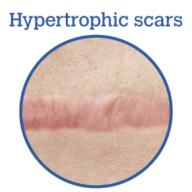 Hypertrophic Scars
