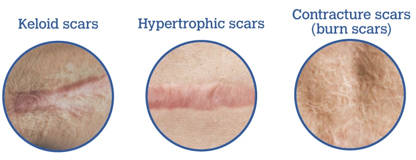 Keloid, hypertrophic and contracture (burn) scars
