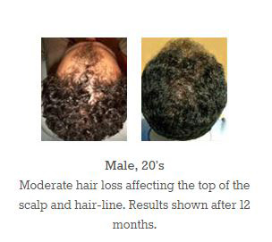 hair loss shampoo results 
