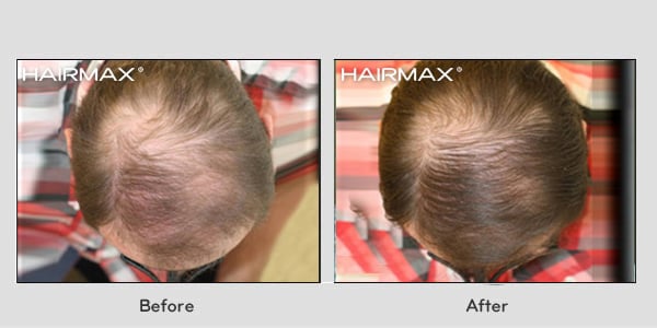 before and after hair growth with lasercomb treatment
